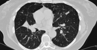 Что нужно знать о КТ лёгких Что нужно знать о КТ лёгких